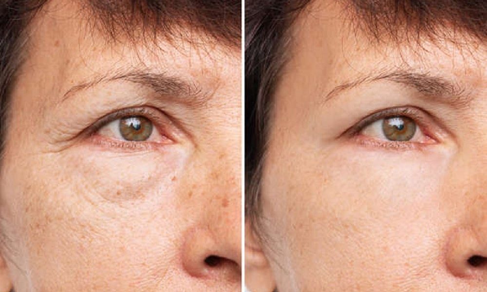 How to reduce eye bags effectively.